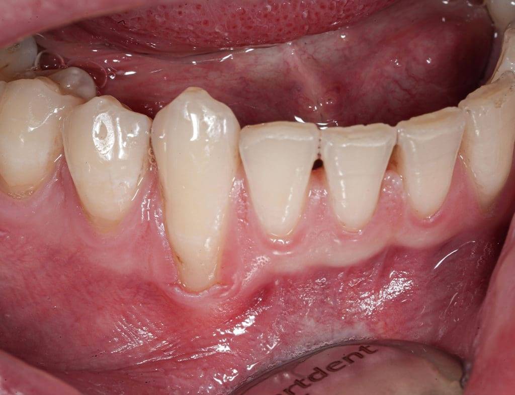 Zahnfleischentzündung 1