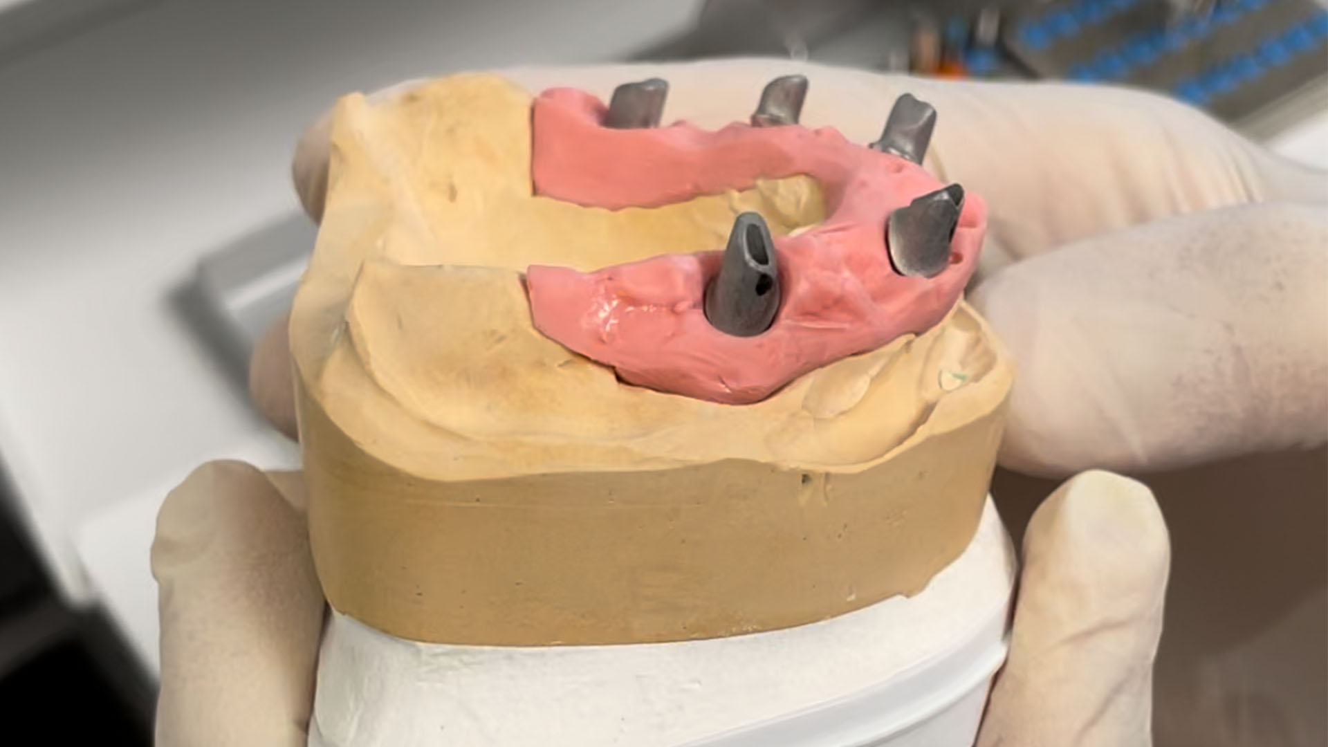 Implantat-Modell mit Aufbauten für Kronen und Brücken