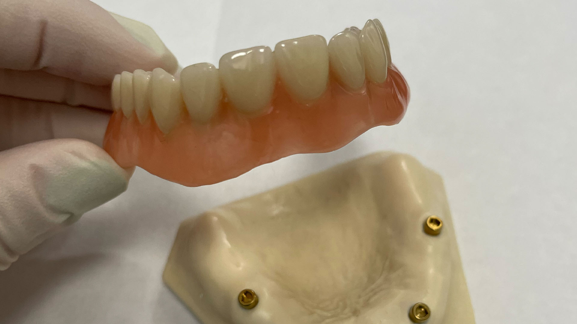 Implantatgetragene Prothese auf Modell – Zahnersatz aus dem hauseigenen Labor