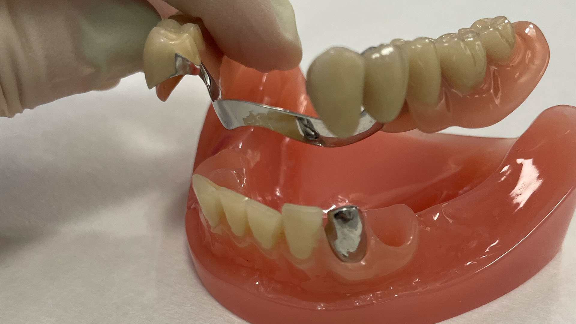 Teilprothese mit Klammern auf Kiefermodell