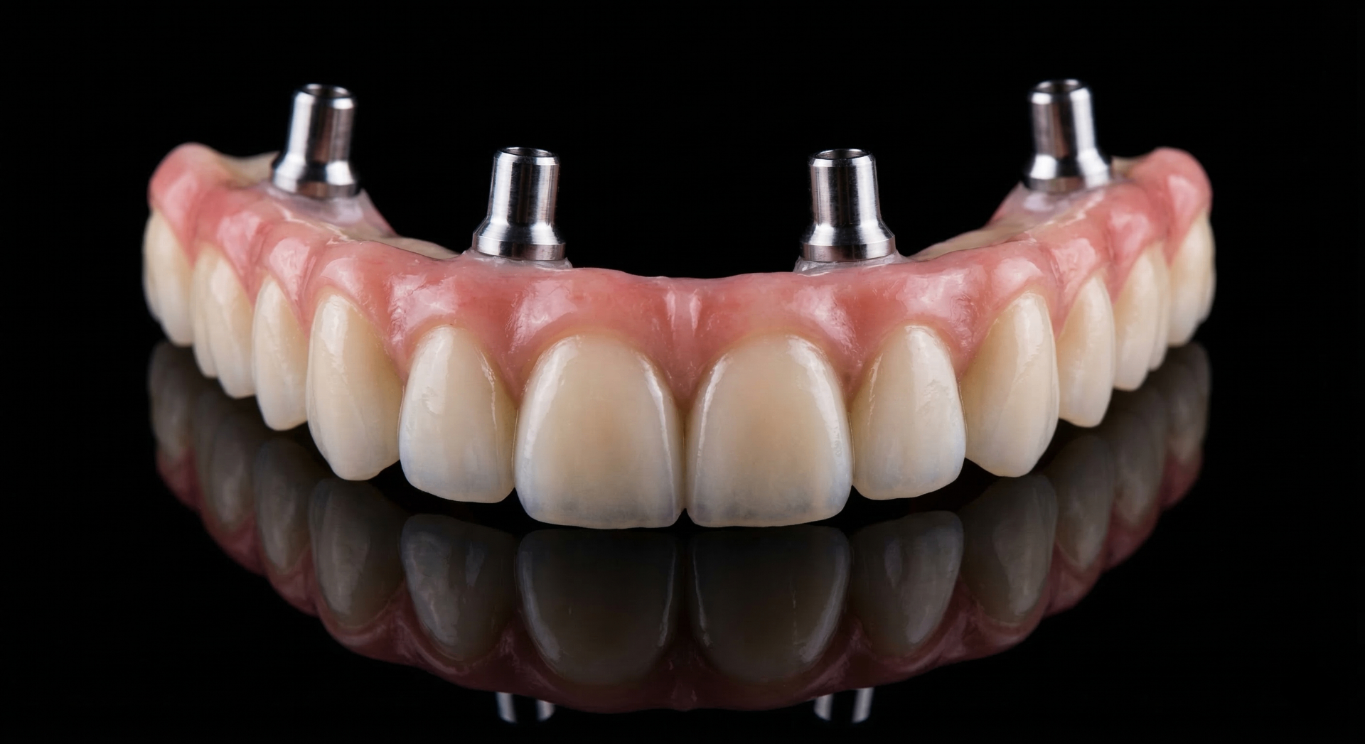 All-on-4 Zahnersatz auf Implantaten – Oberkiefer