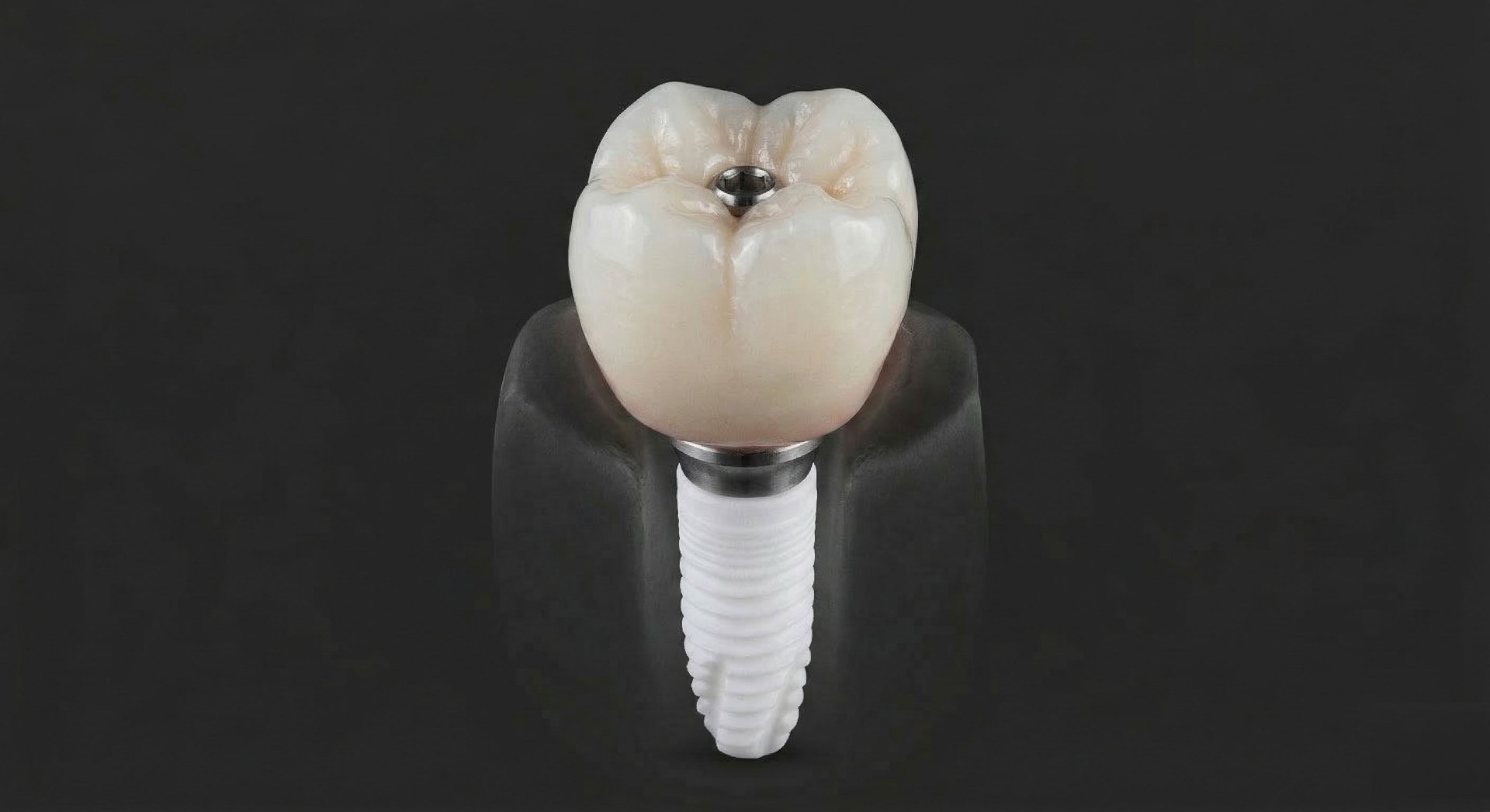 Keramikimplantate