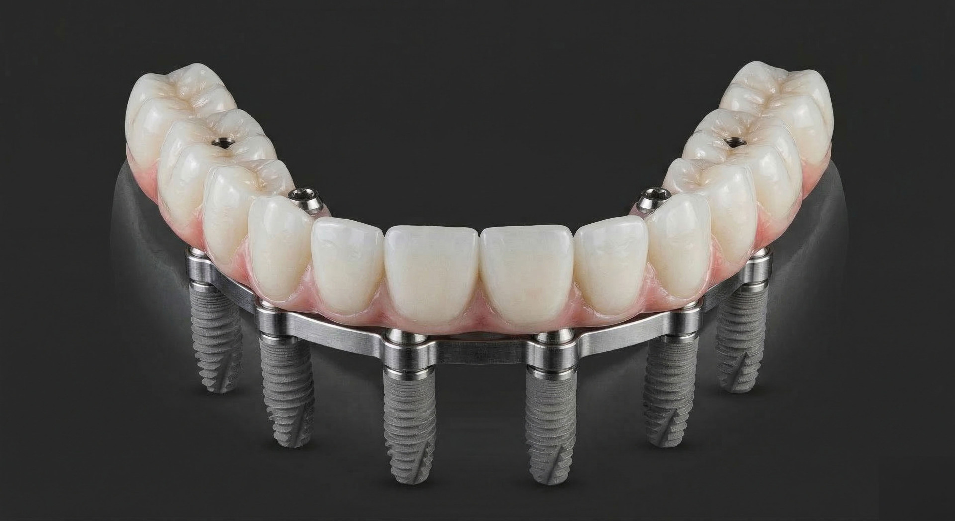 Implantatgetragene Vollversorgung